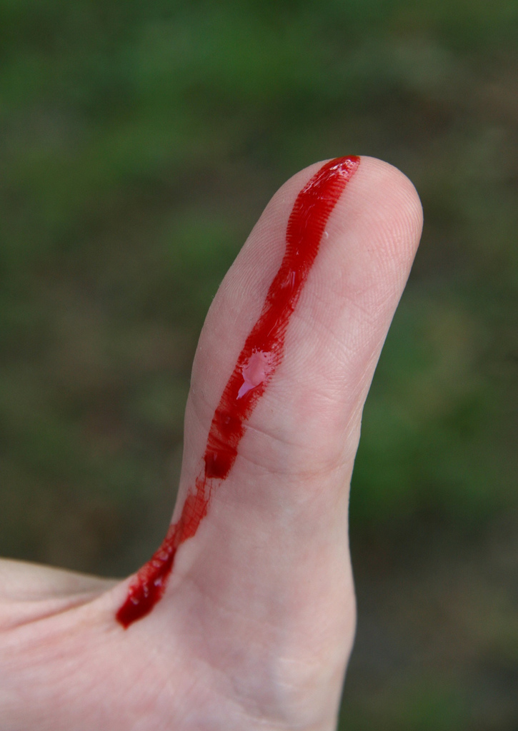 on the picture you see a bleeding finger